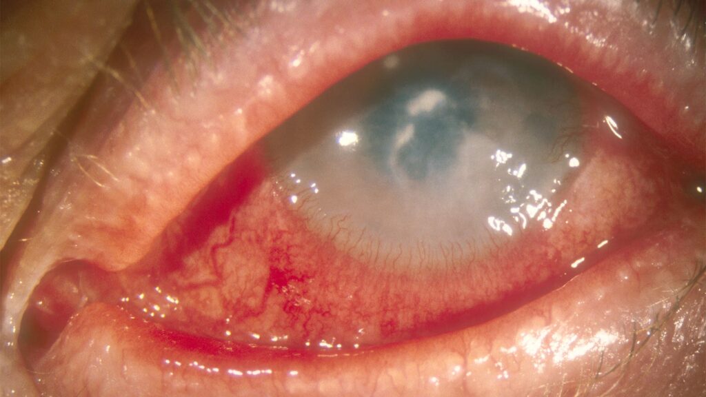 EGFR Inhibitors for Lung Cancer Tied to Increased Keratitis Risk