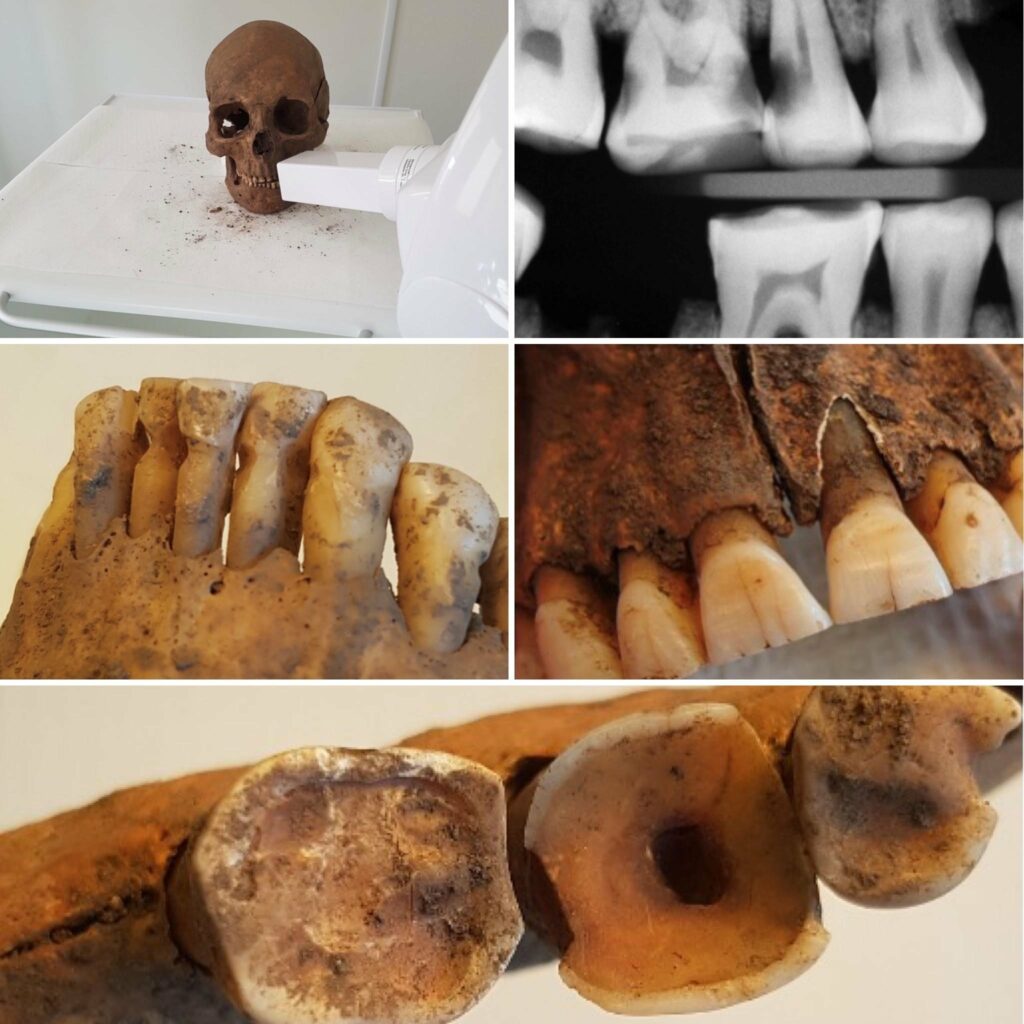 New Research Reveals That Viking Dentistry Was Surprisingly Advanced