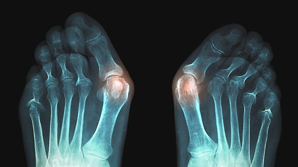 Bunions are a failure of evolution. Here’s why—and how to treat them.