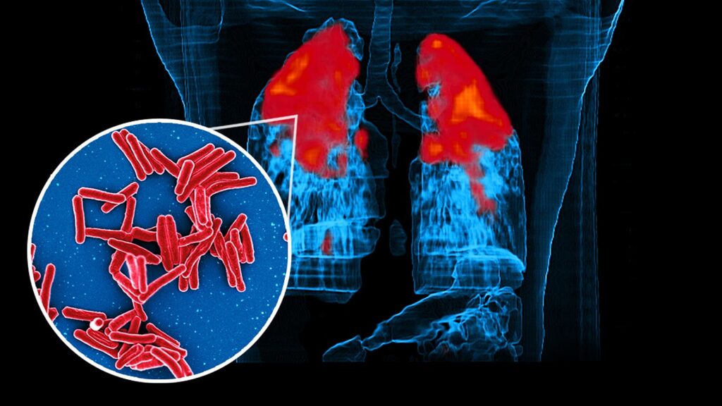 Risk-Targeted Preventive TB Treatment Works, Particularly With Infection Testing