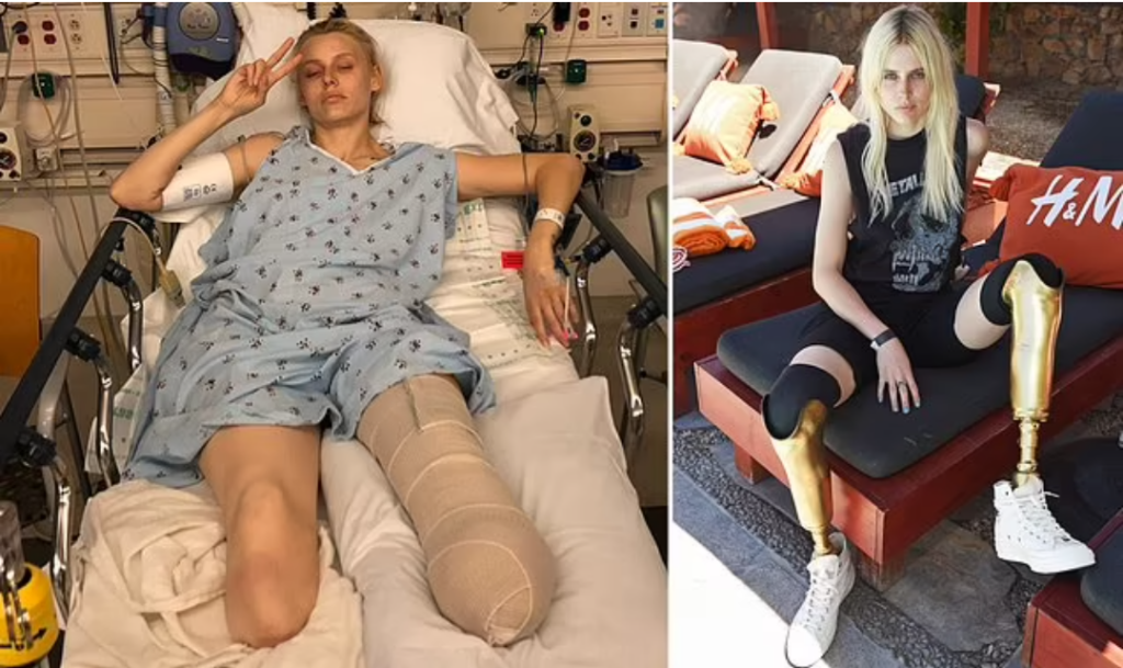 Model Issues Urgent Warning To Other Women As She Recalls How She Lost Her Two Legs After Using A Tampon