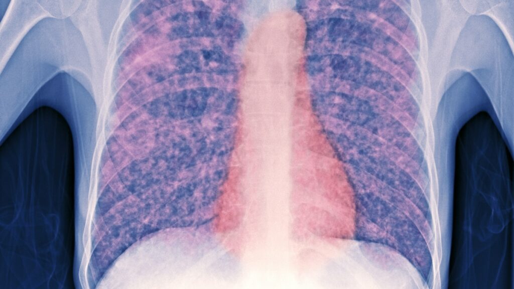 Tuberculosis is rising in the U.S. again. How did we get here?