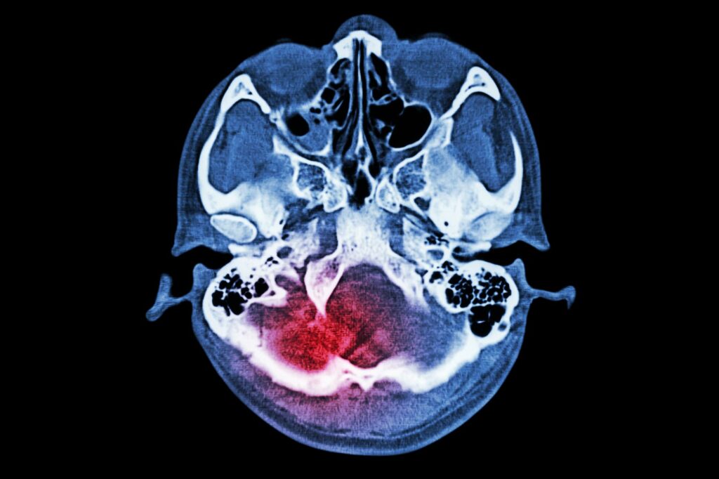 New Study: Light Therapy Enhances Brain Connectivity After Injury