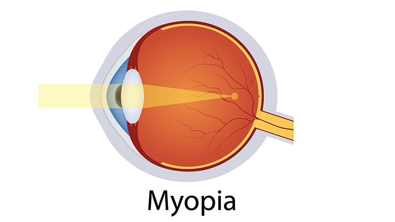 Red Light Therapy Curbs High Myopia in Children
