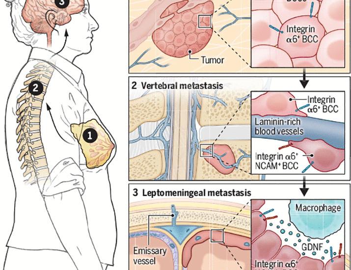 An unexpected corridor to brain metastasis | Science