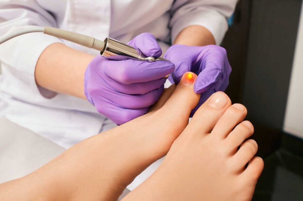 Cold Air Plasma Jets Redefine Fungal Nail Treatment