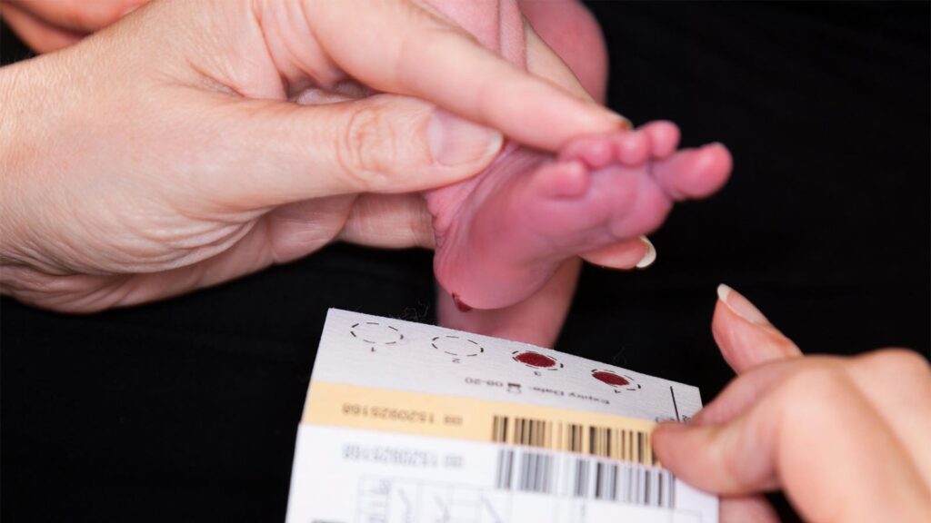 Newborn Screening Downgrades Prevalence of SMA