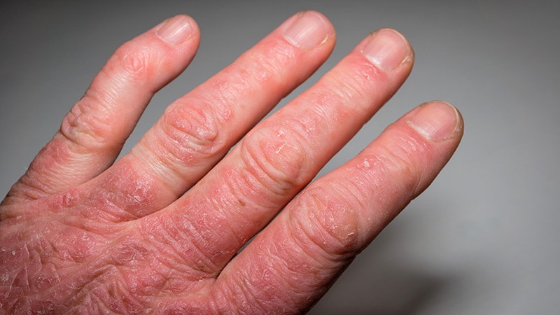 Psoriatic Arthritis Treatment Failure Tied to Key Factors