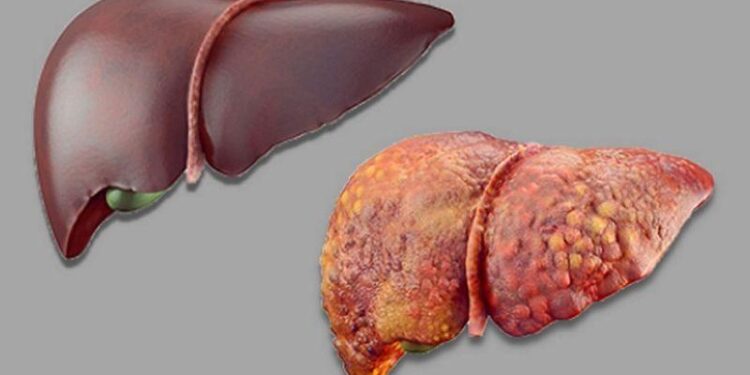 Can liver damage from alcohol be reversed? Doctor reveals truth – Hindustan Times