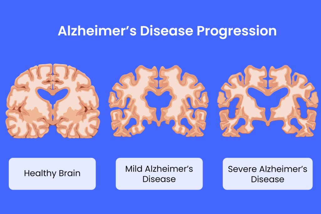 AI Discovers Suspected Trigger of Alzheimer’s, And Maybe a Treatment – ScienceAlert
