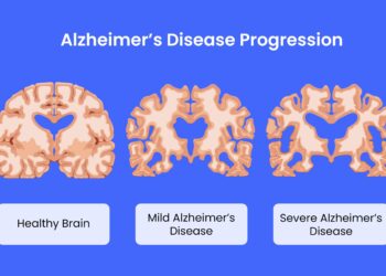 AI Discovers Suspected Trigger of Alzheimer’s, And Maybe a Treatment – ScienceAlert