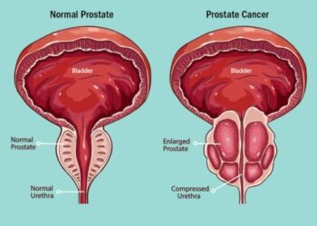 What a Prostate Cancer Diagnosis Like Biden’s Means for Patients – The New York Times