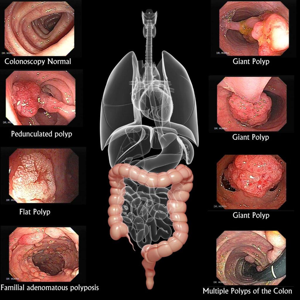 Can Lifestyle Changes Save Lives in Colon Cancer? – Medscape