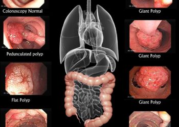 Can Lifestyle Changes Save Lives in Colon Cancer? – Medscape