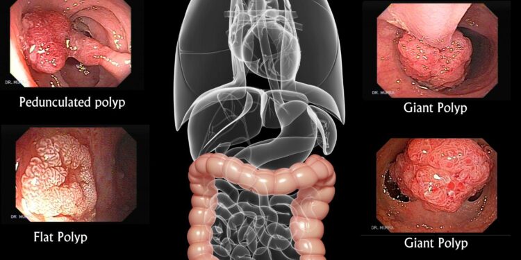 Can Lifestyle Changes Save Lives in Colon Cancer? – Medscape