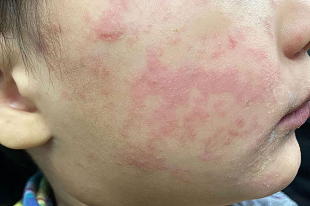 Health officials warn of measles case from traveler at Dulles Airport – The Washington Post