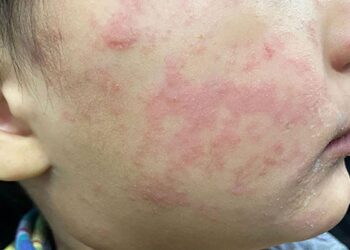 Health officials warn of measles case from traveler at Dulles Airport – The Washington Post