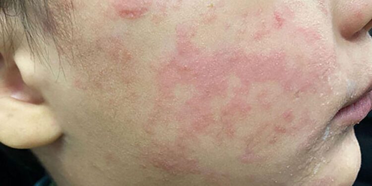 Health officials warn of measles case from traveler at Dulles Airport – The Washington Post