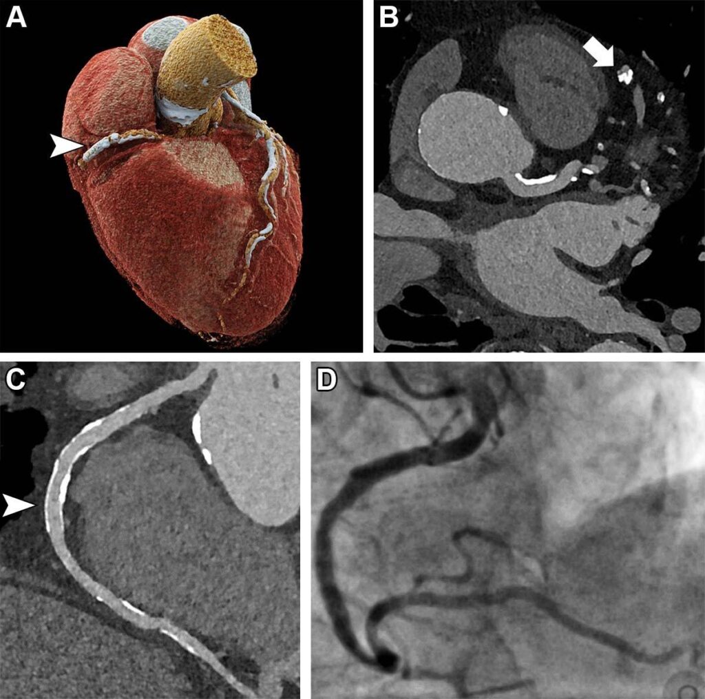 CCTA Bests CV Risk Scores for Bolstering Lifestyle Changes, Medication Uptake – TCTMD.com
