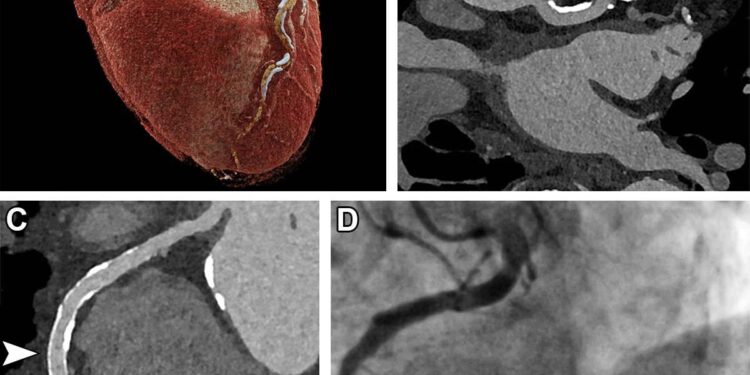 CCTA Bests CV Risk Scores for Bolstering Lifestyle Changes, Medication Uptake – TCTMD.com