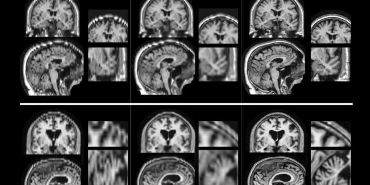 Why does your mind goes ‘blank’? New brain scans reveal the surprising answer – Live Science