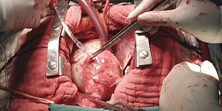 Heart Surgery – UT Health East Texas