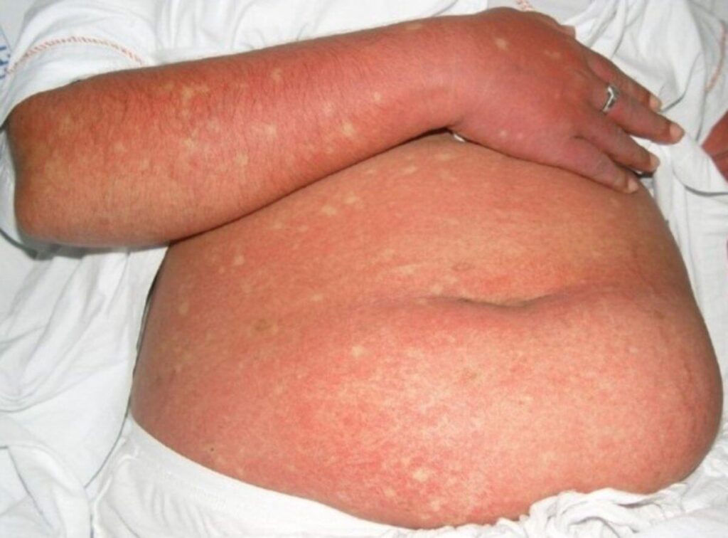 Dengue – World Health Organization (WHO)