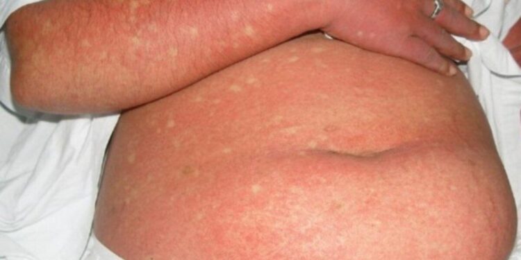 Dengue – World Health Organization (WHO)