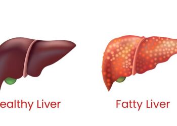 8 Lifestyle Changes To Reverse Fatty Liver Naturally – iDiva