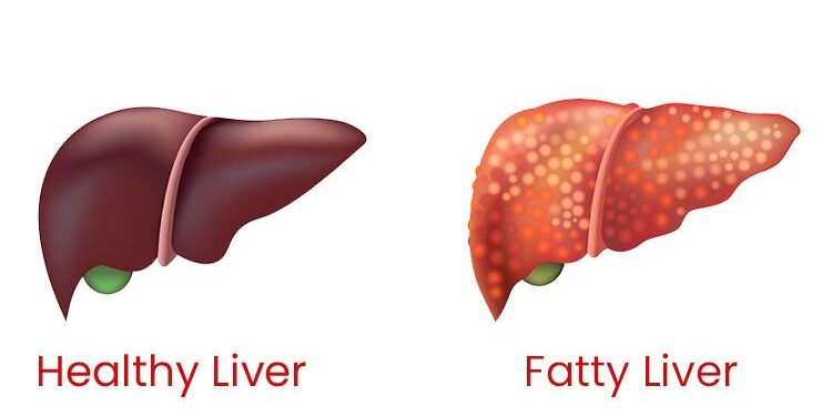 8 Lifestyle Changes To Reverse Fatty Liver Naturally – iDiva