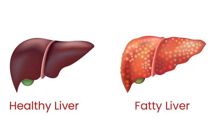 8 Lifestyle Changes To Reverse Fatty Liver Naturally – iDiva