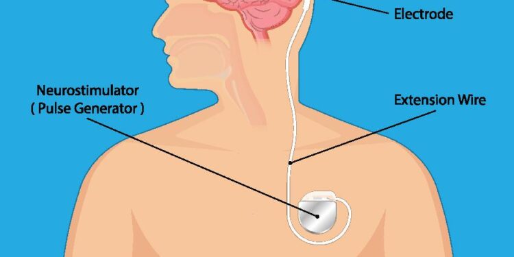 Science and artificial intelligence could help personalize brain stimulation for smokers – News-Medical