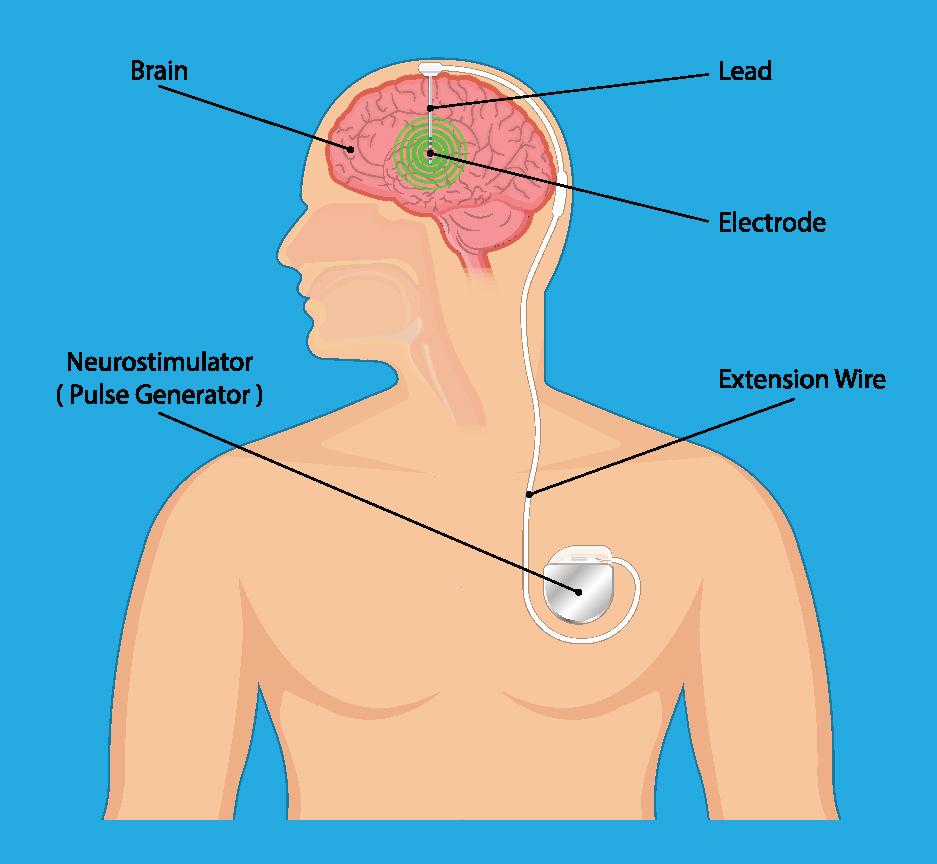 Science and artificial intelligence could help personalize brain stimulation for smokers – News-Medical
